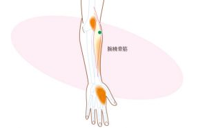 腕橈骨筋のトリガーポイント