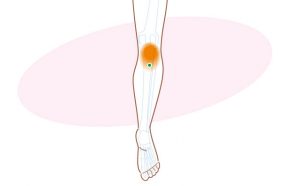膝窩筋のトリガーポイント
